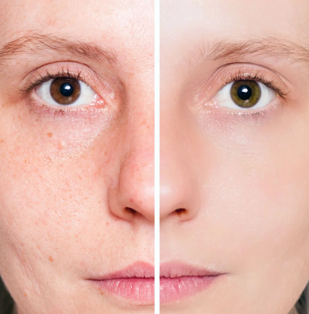 Przebarwienia na twarzy - metody redukcji